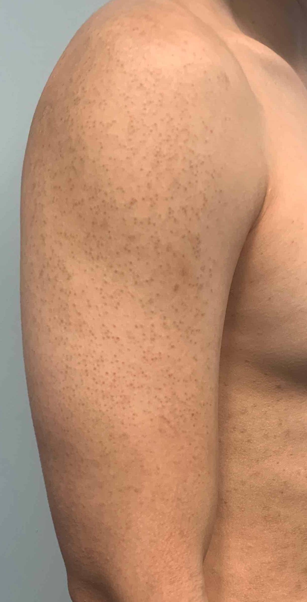 Eczema Before and After Case 9 After