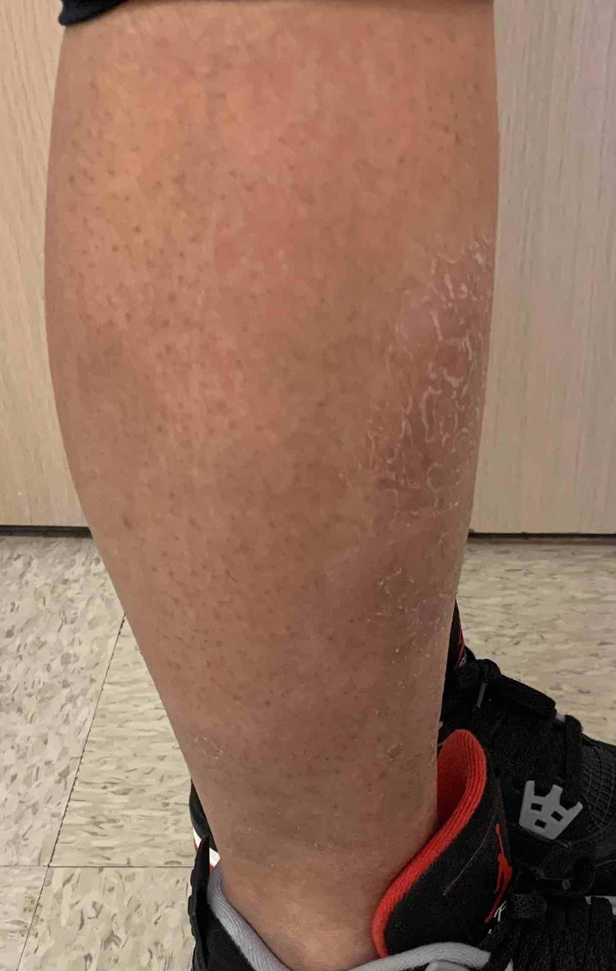 Psoriasis Before and After Case 26 After
