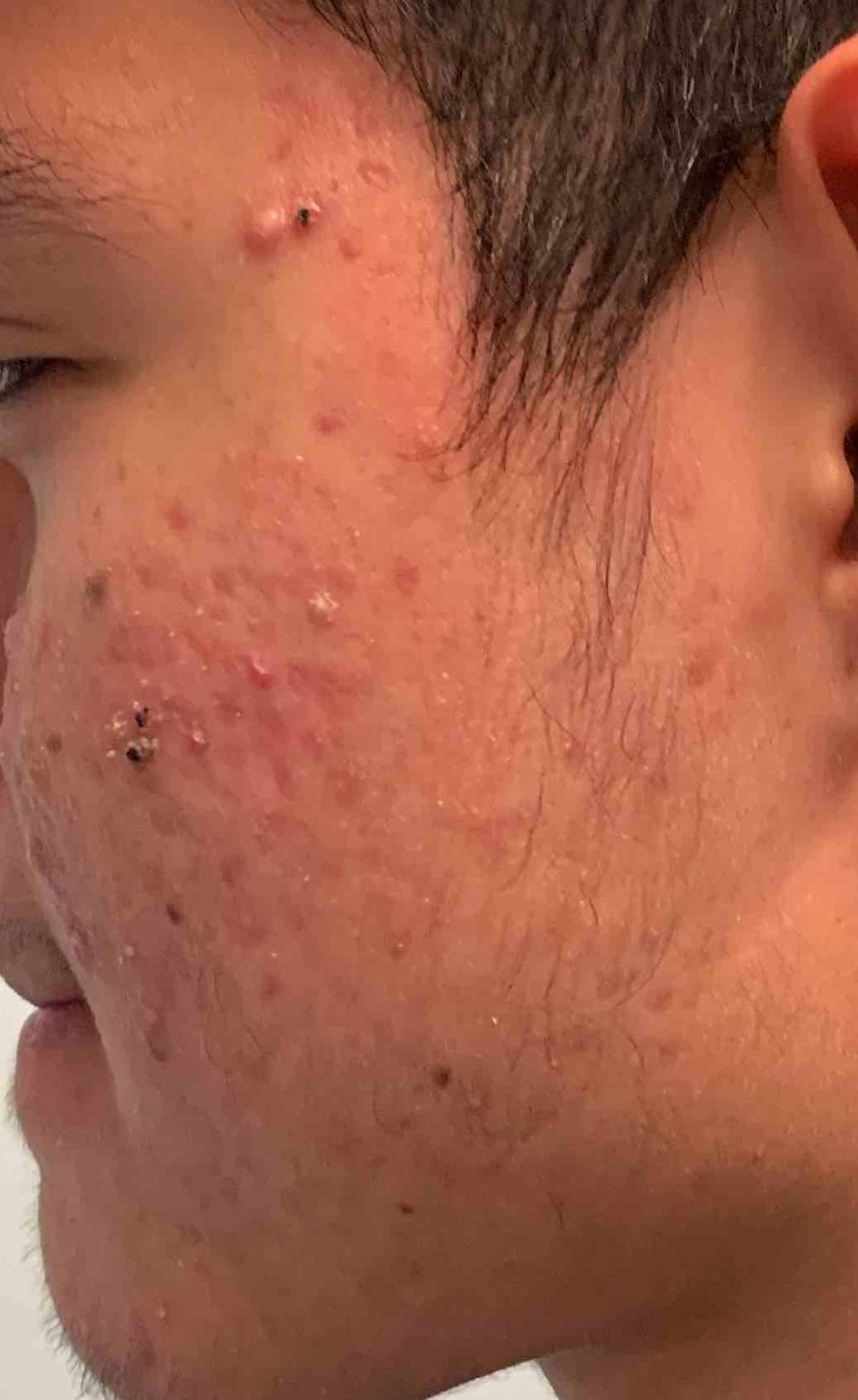 Acne Before and After Case 10 Before