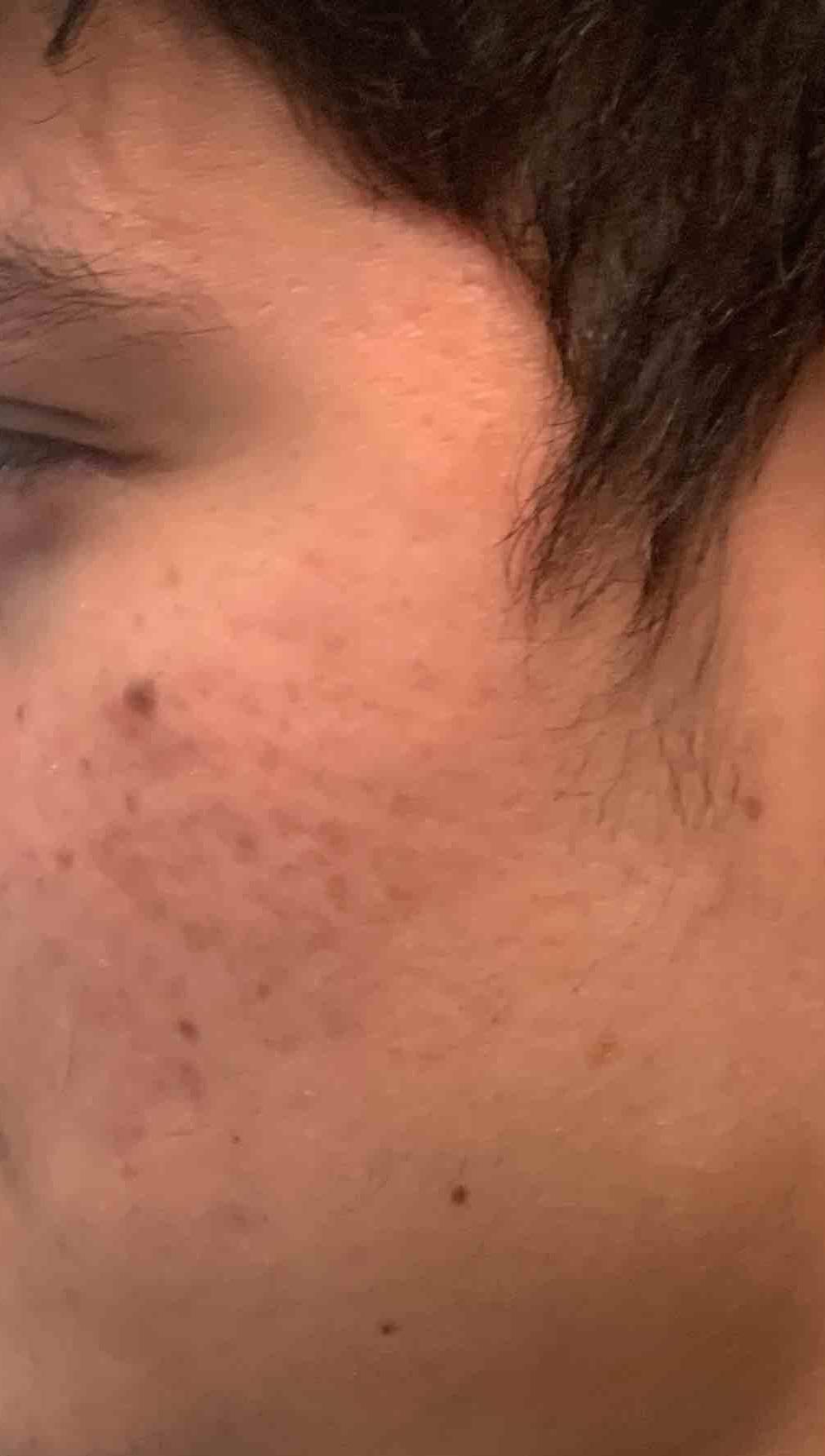 Acne Before and After Case 10 After