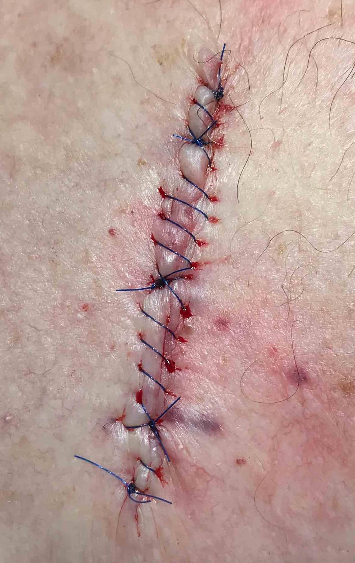 Skin Cancer Before and After Case 9 Before