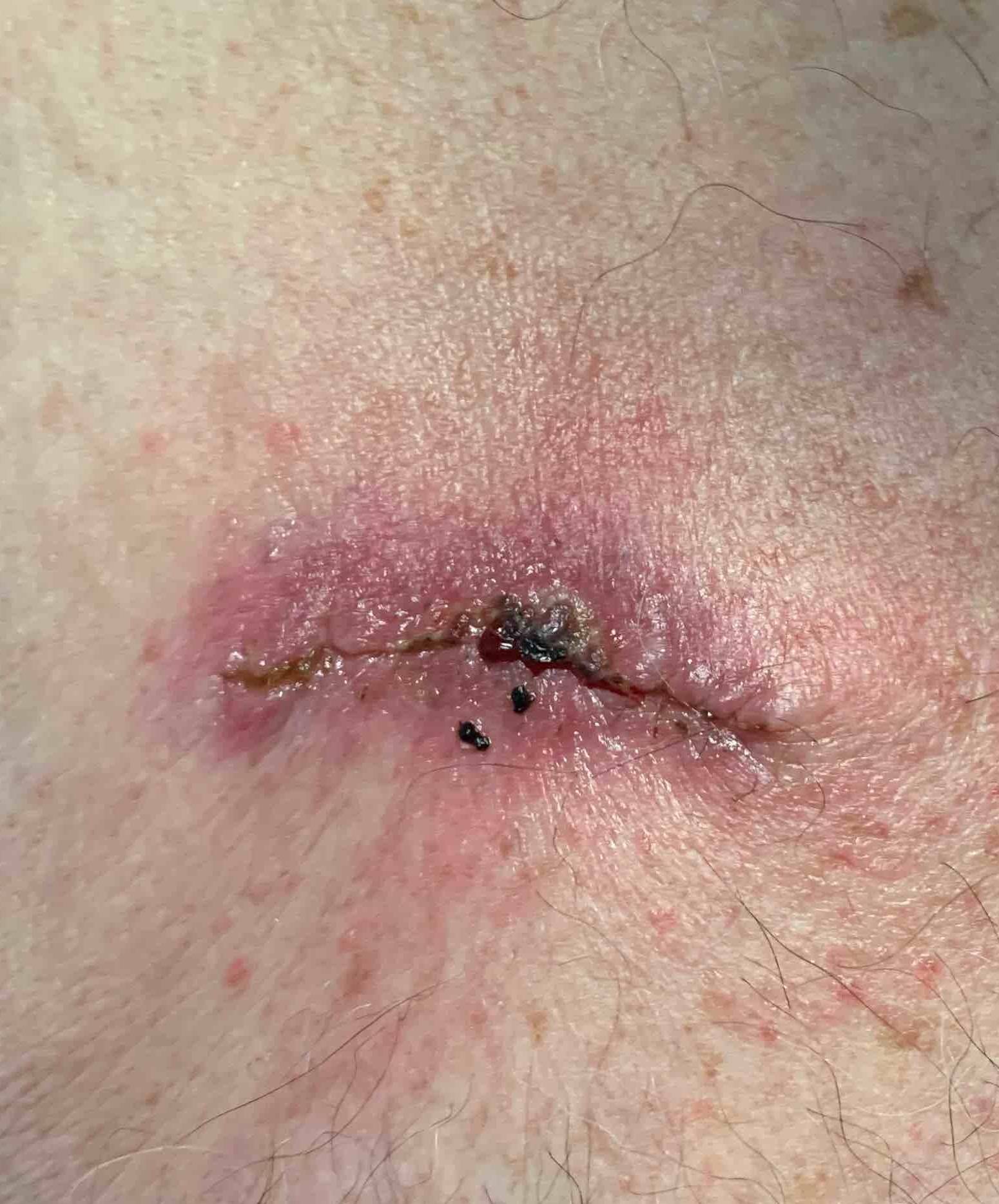 Skin Cancer Before and After Case 9 After