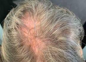 Platelet-Rich Plasma Before and After Case 3 Before
