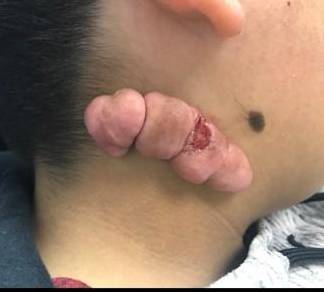 Keloids Before and After Case 2 Before