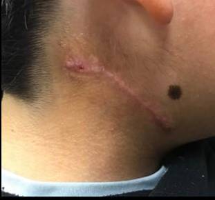 Keloids Before and After Case 2 After