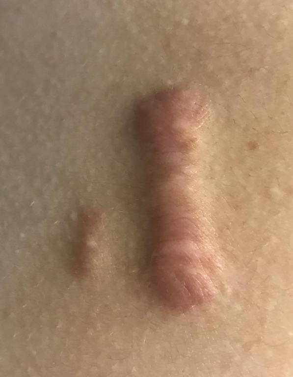 Keloids Before and After Case 3 Before