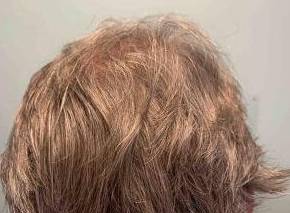 Platelet-Rich Plasma Before and After Case 3 After