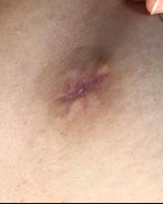 Keloids Before and After Case 3 After