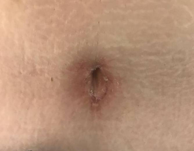 Keloids Before and After Case 4 After