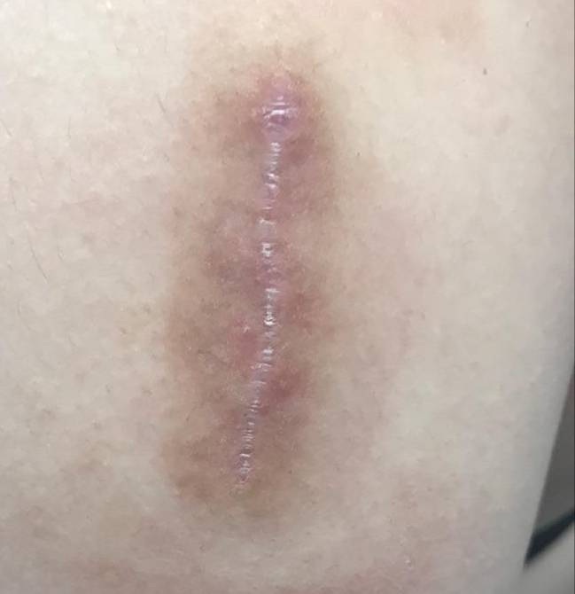 Keloids Before and After Case 5 After