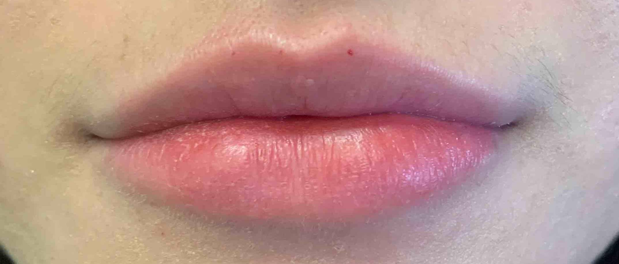 Juvederm (1 Syringe) Case 15 After