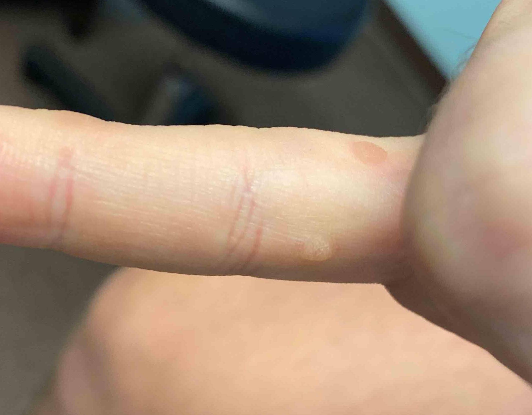 Wart Before and After Before