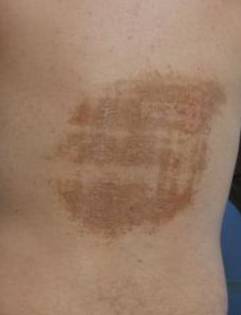 Micro-Needling Before and After Case 1 Before
