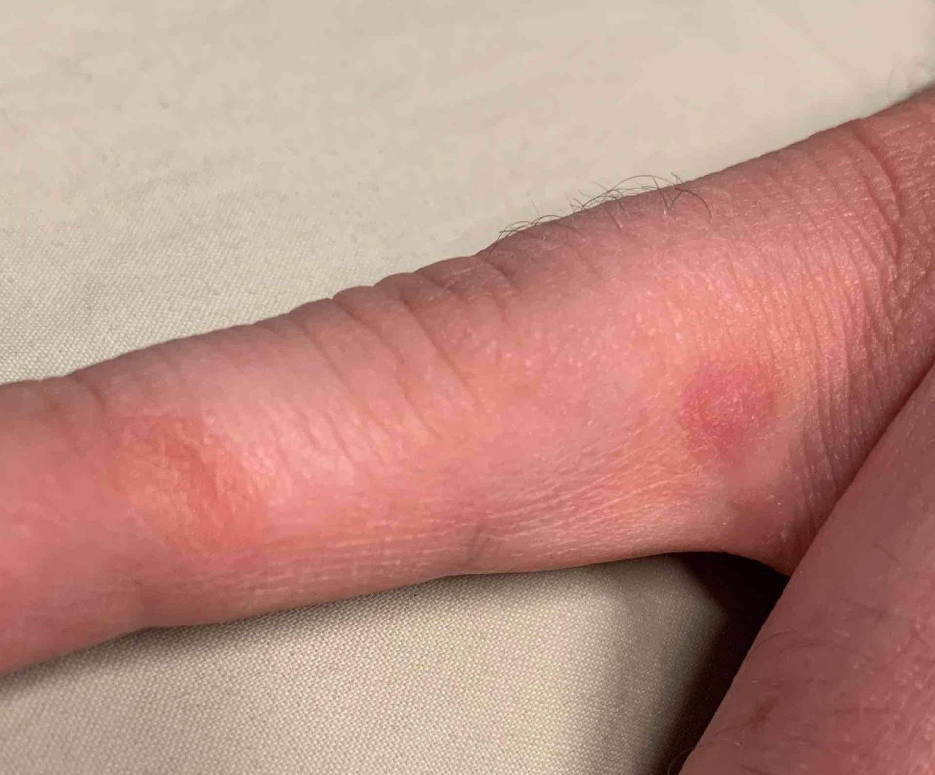 Wart Before and After After