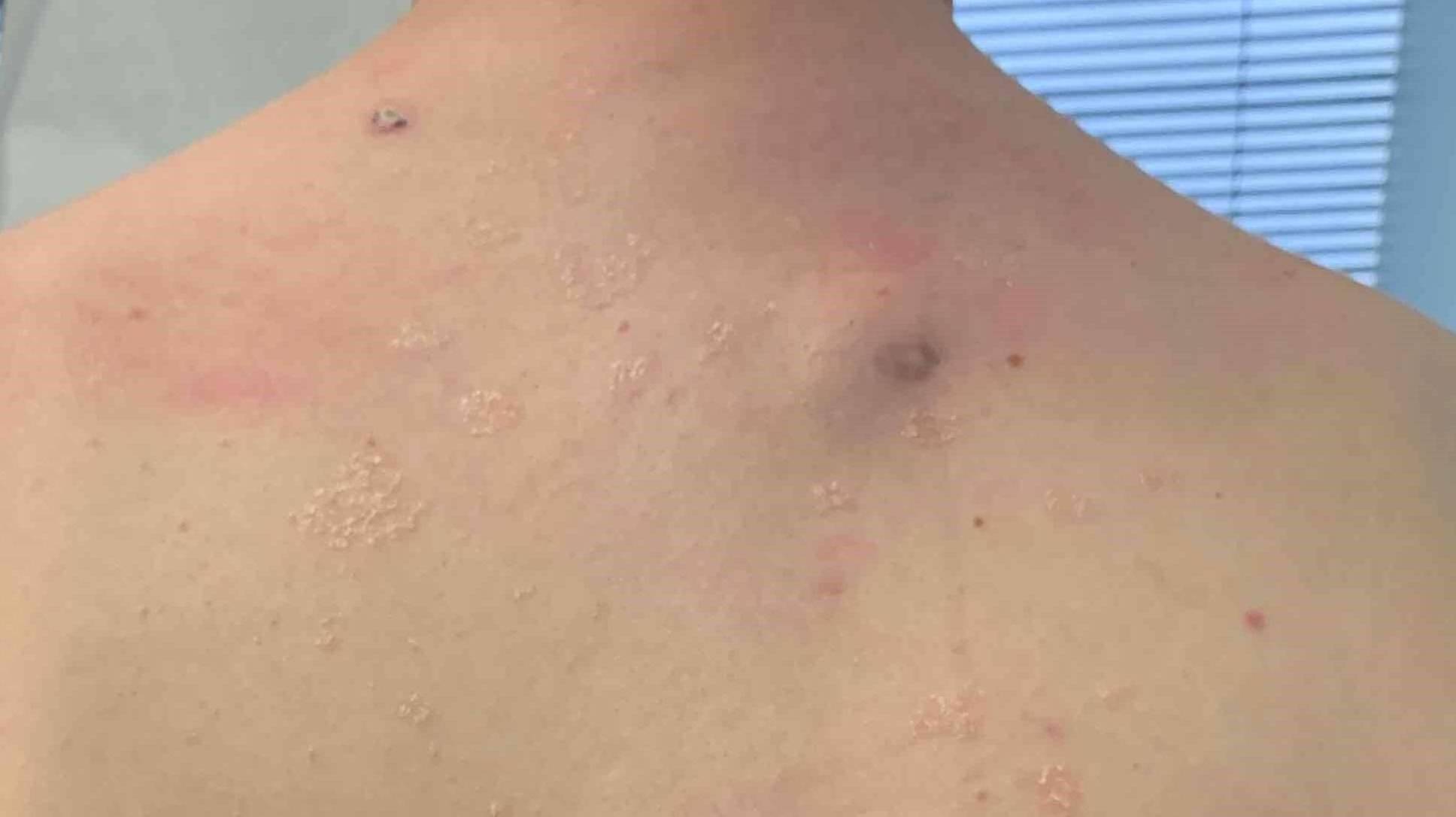 Cyst Removal Before and After Case 5 Before