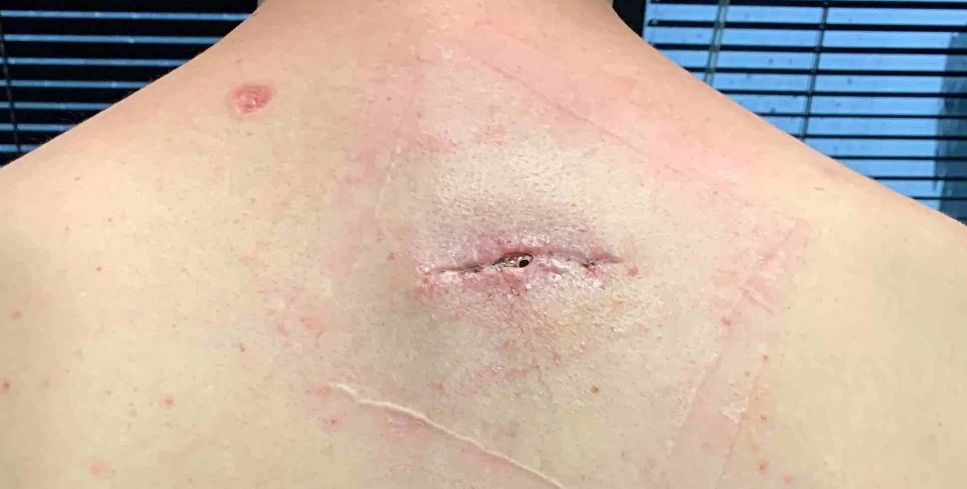Cyst Removal Before and After Case 5 After