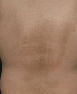 Micro-Needling Before and After Case 1 After