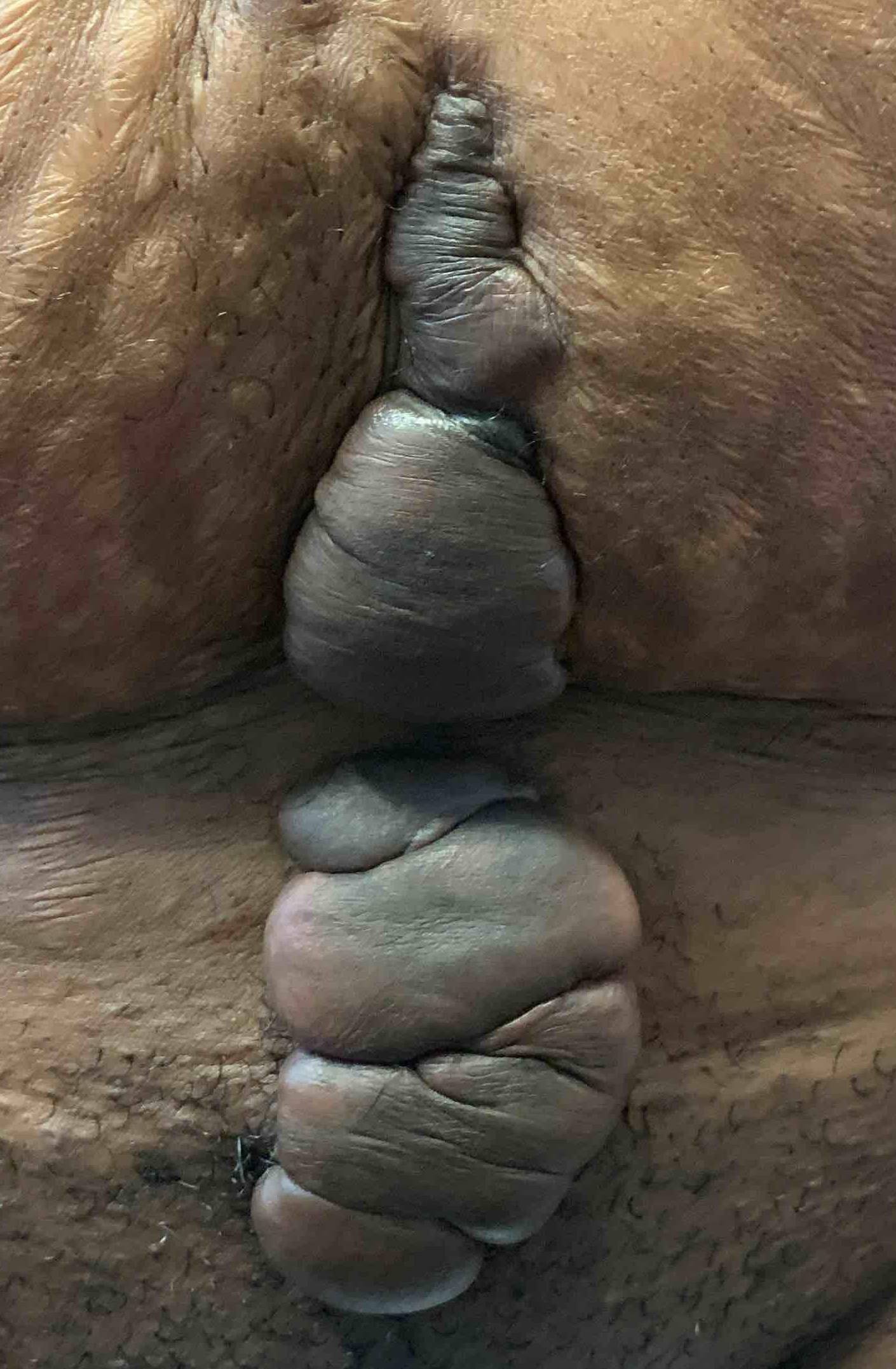 Keloids Before and After Case-6 Before