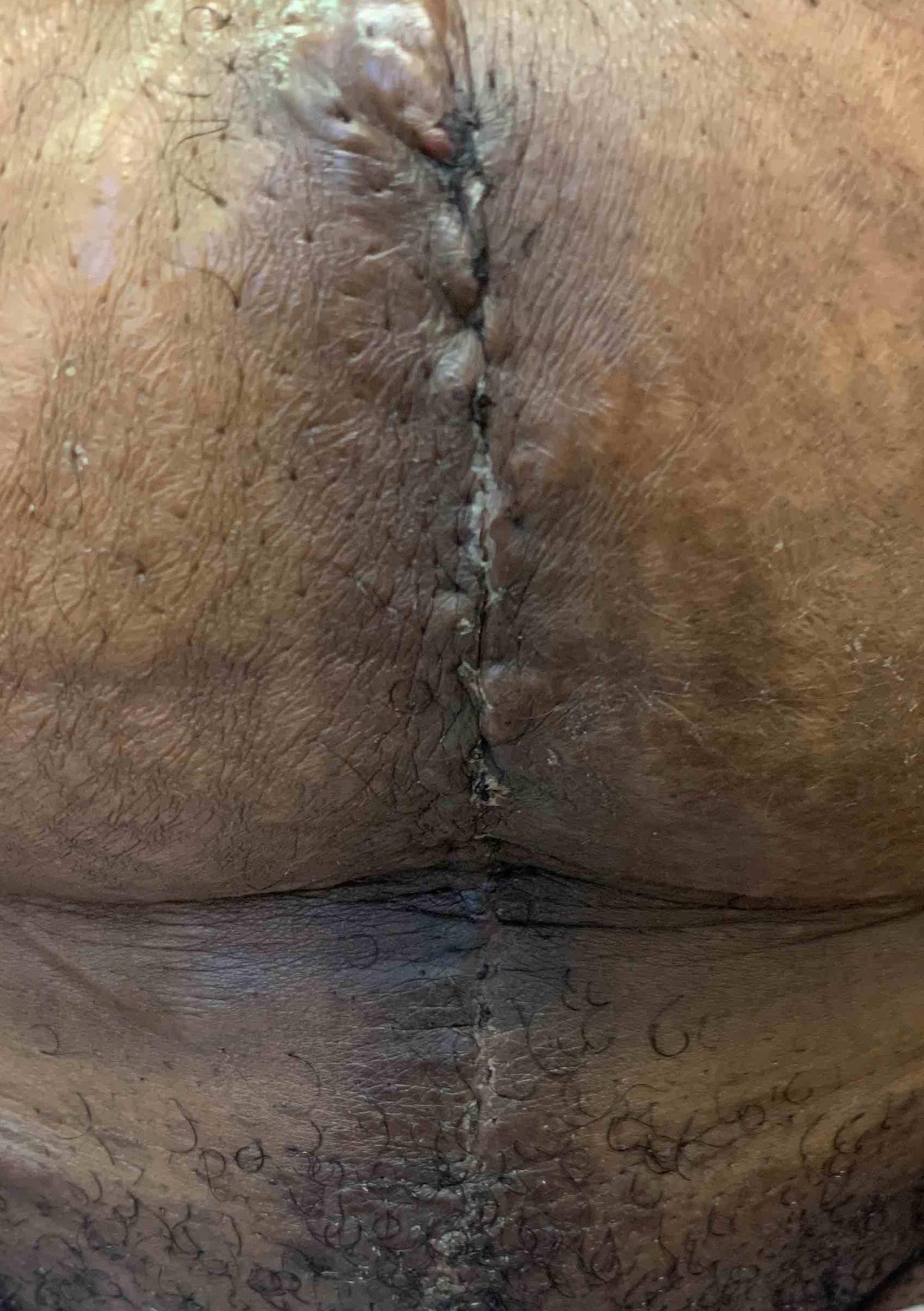 Keloids Before and After Case-6 After
