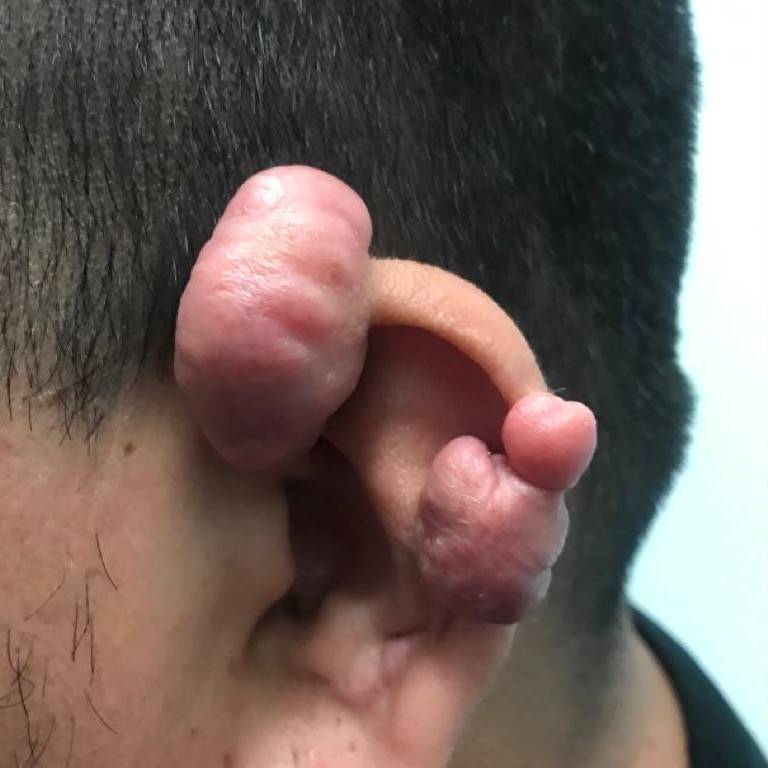 Keloids Before and After Case-7 Before