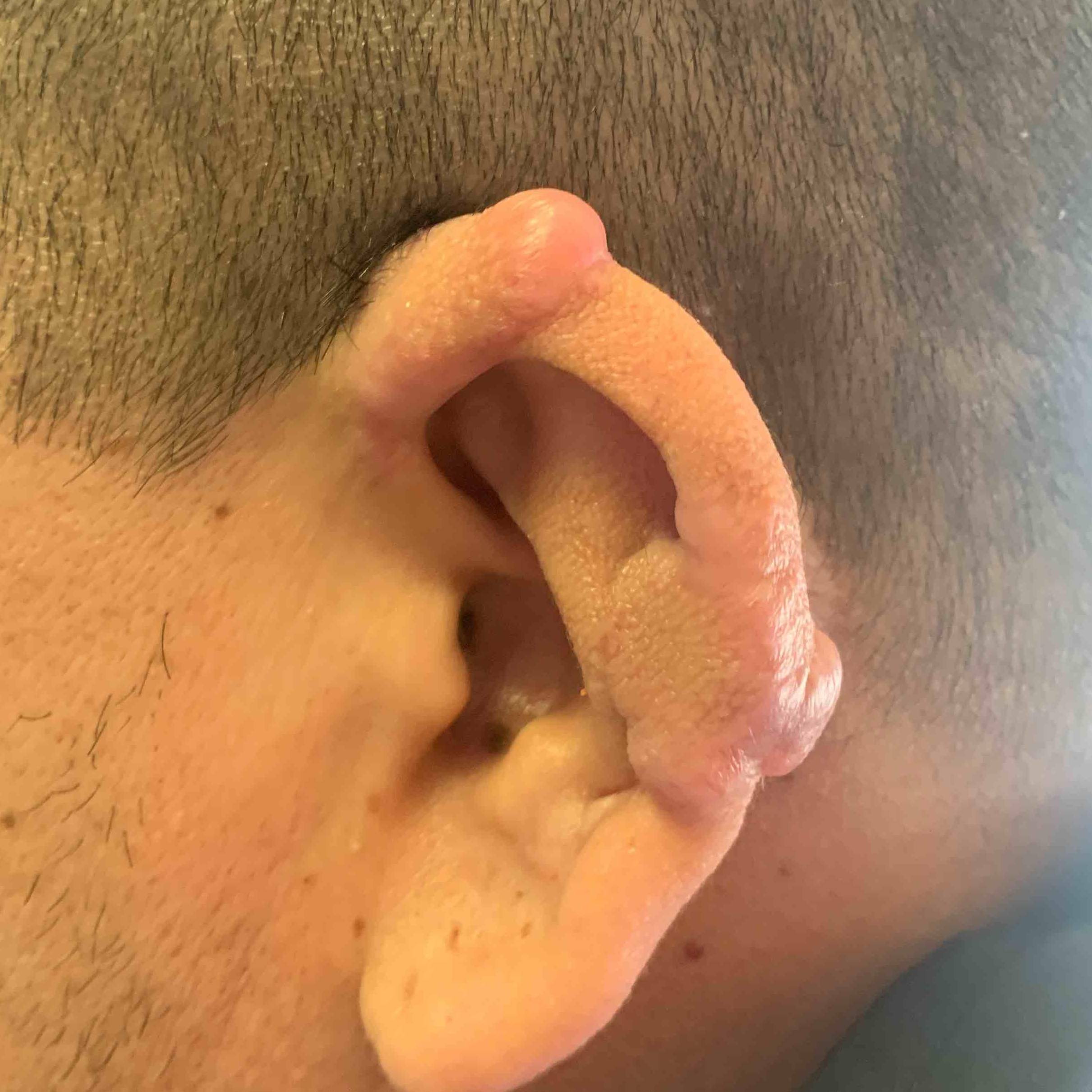 Keloids Before and After Case-7 After