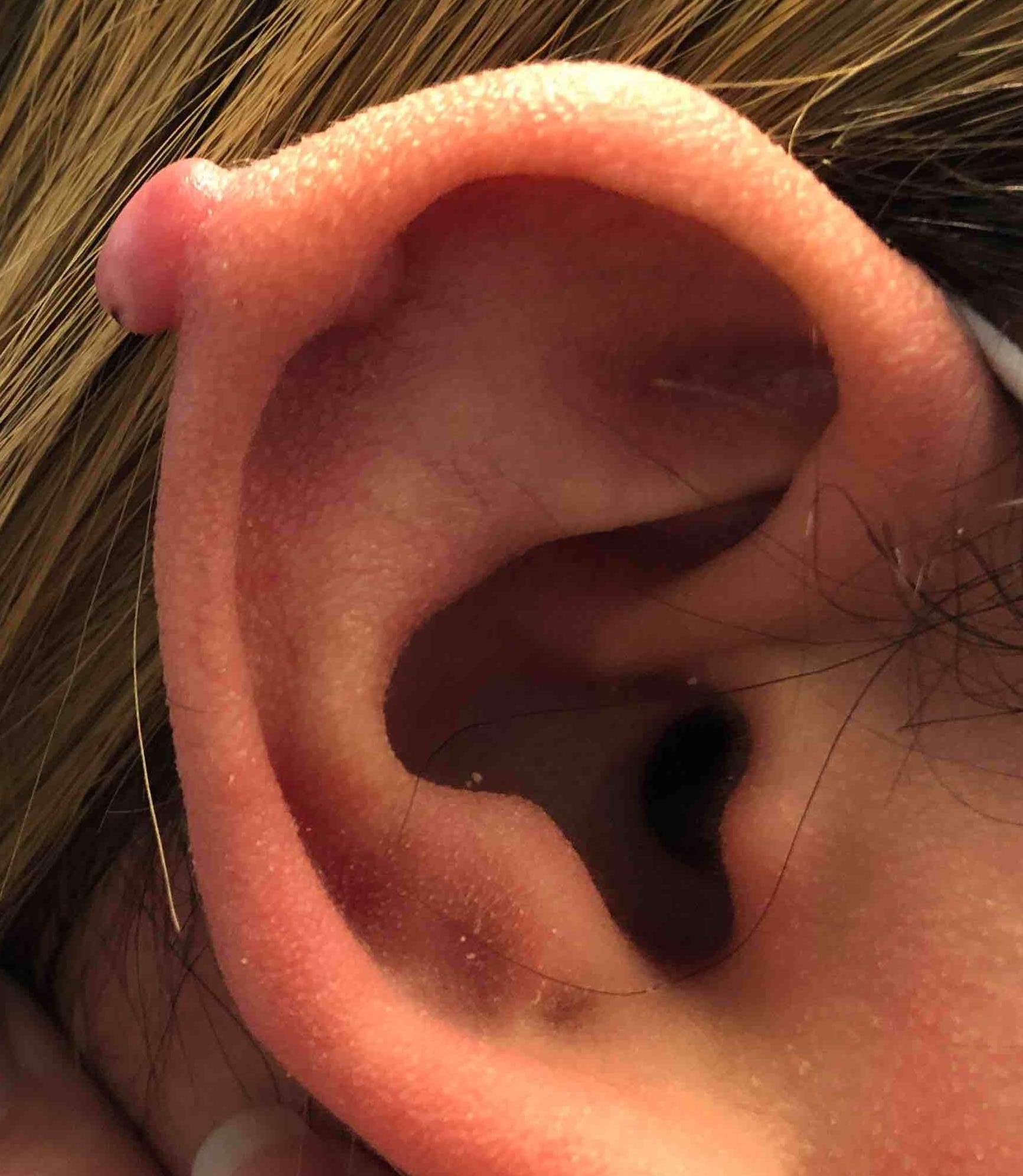 Keloids Before and After Case-8 Before
