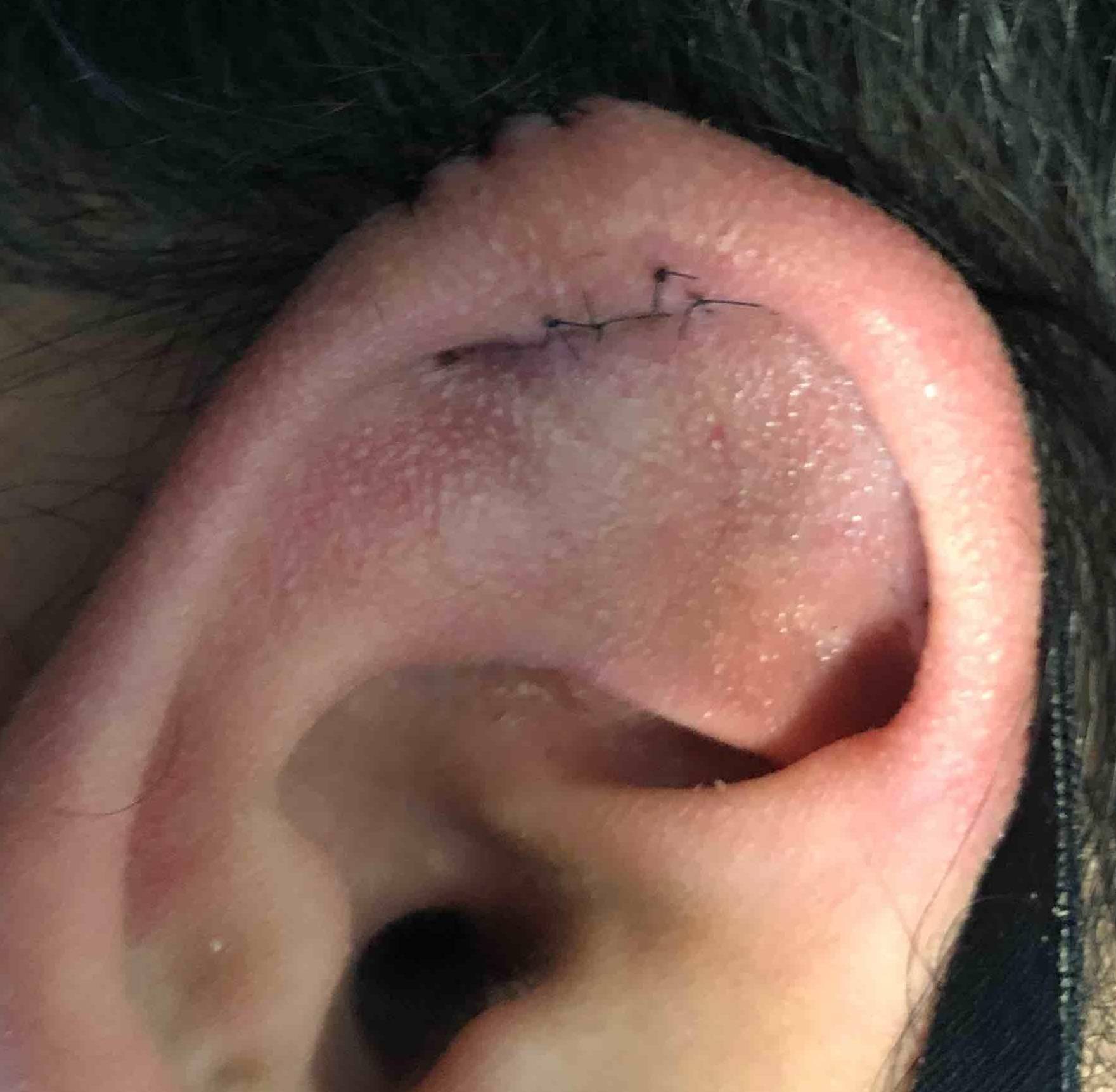 Keloids Before and After Case-8 After