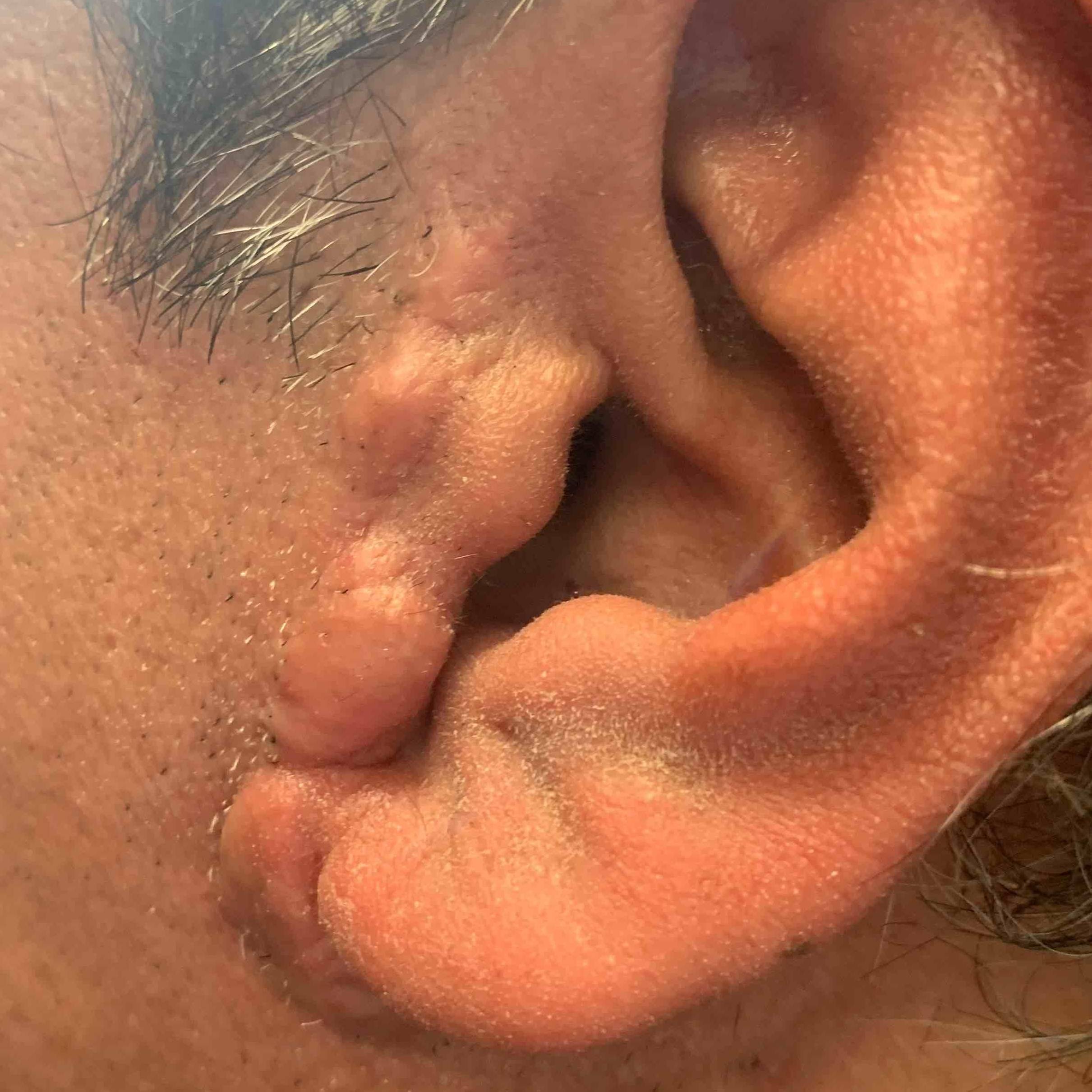 Keloids Before and After Case-9 Before
