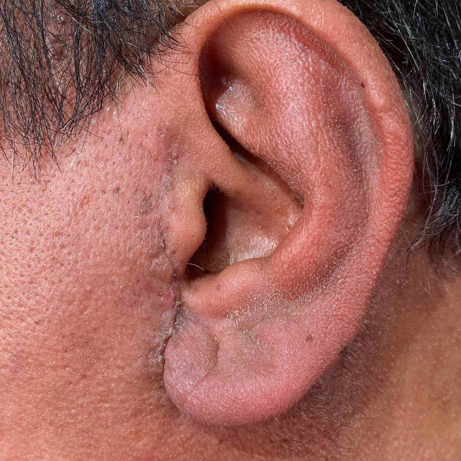 Keloids Before and After Case-9 After