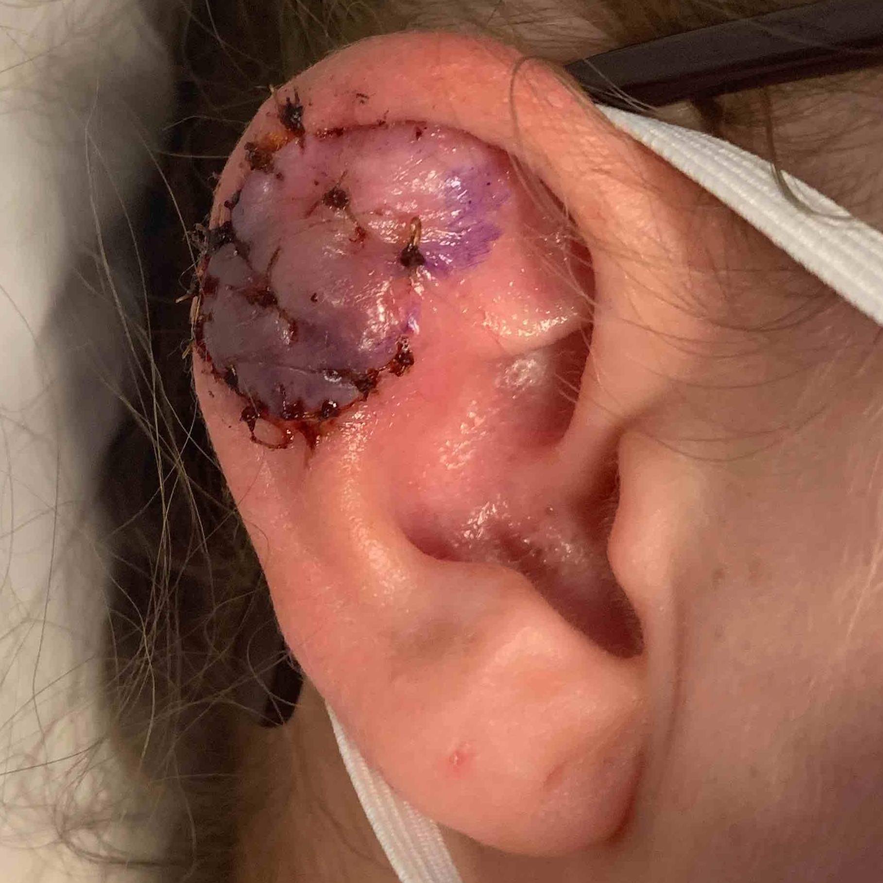 Keloids Before and After Case-10 After