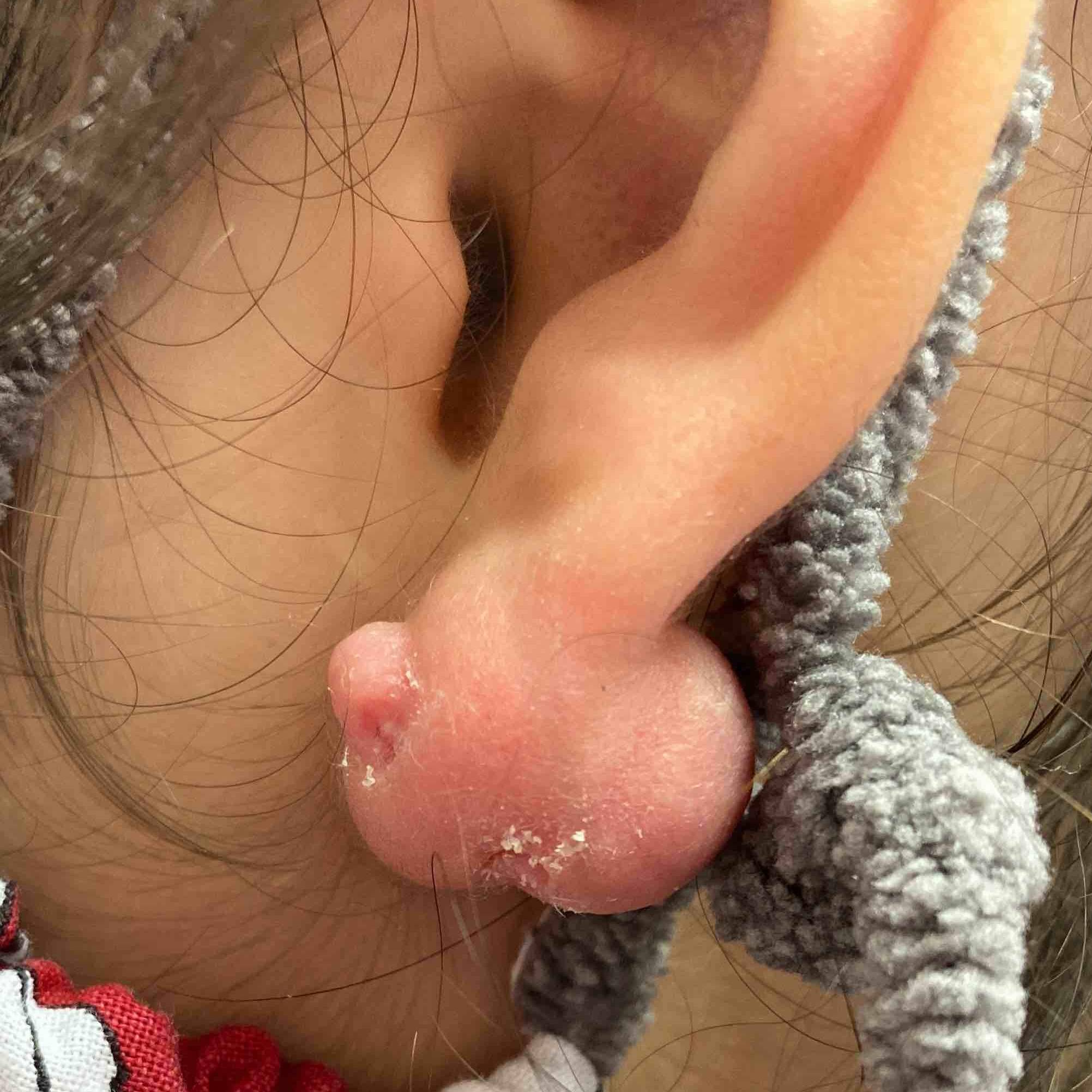 Keloids Before and After Case-11 Before
