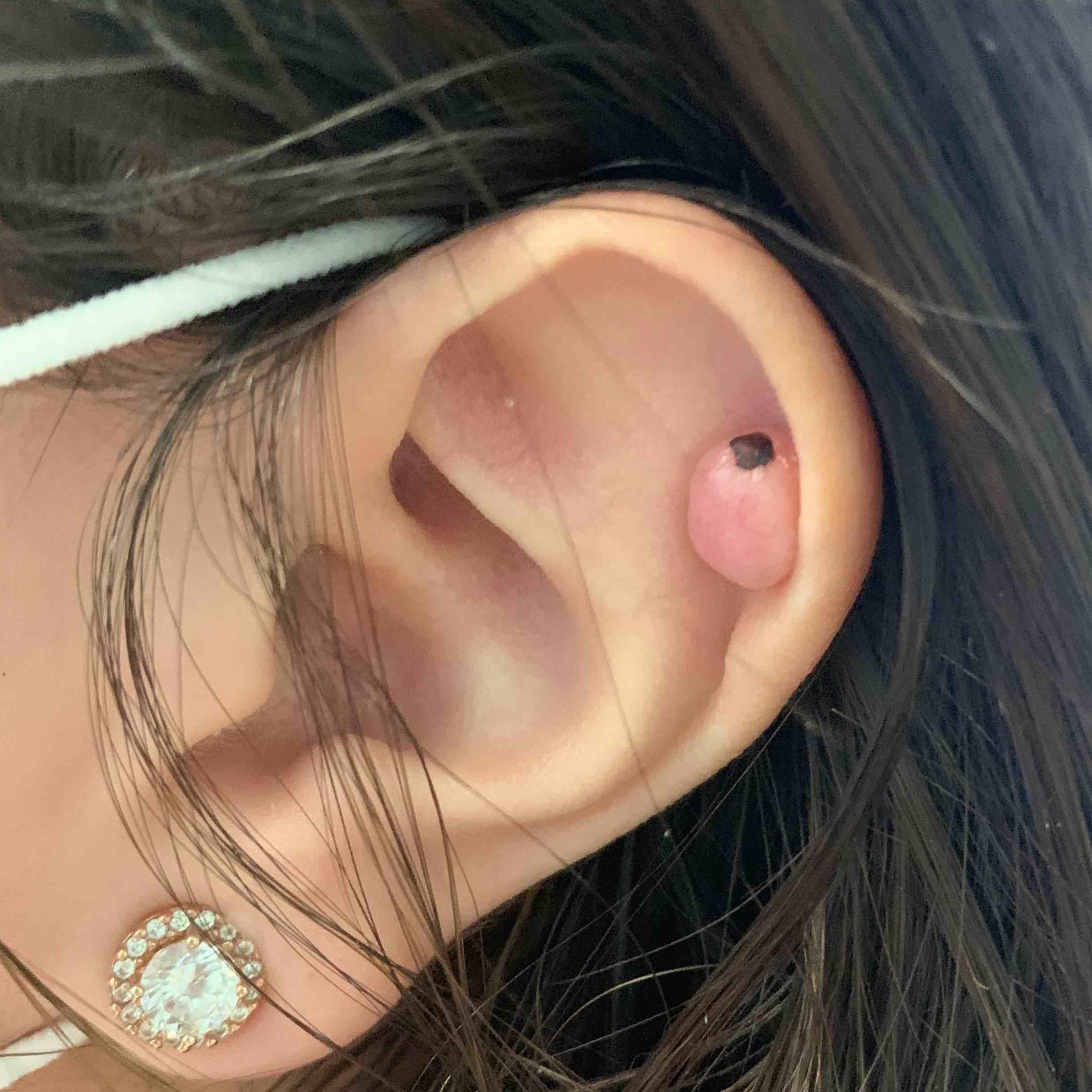 Keloids Before and After Case-12 Before