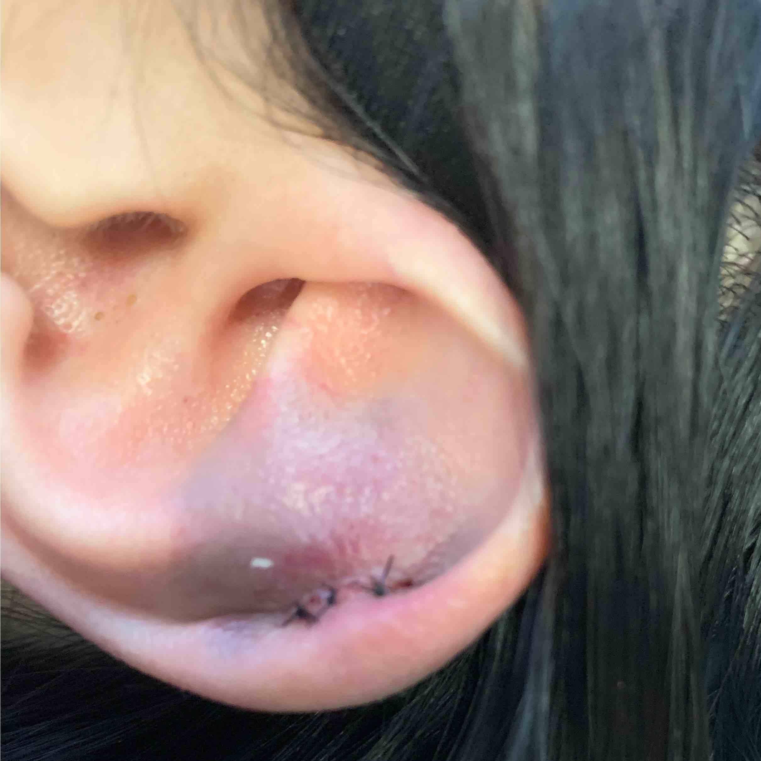 Keloids Before and After Case-12 After