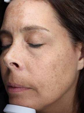 Picocare 450 Before and After Case 2 Before