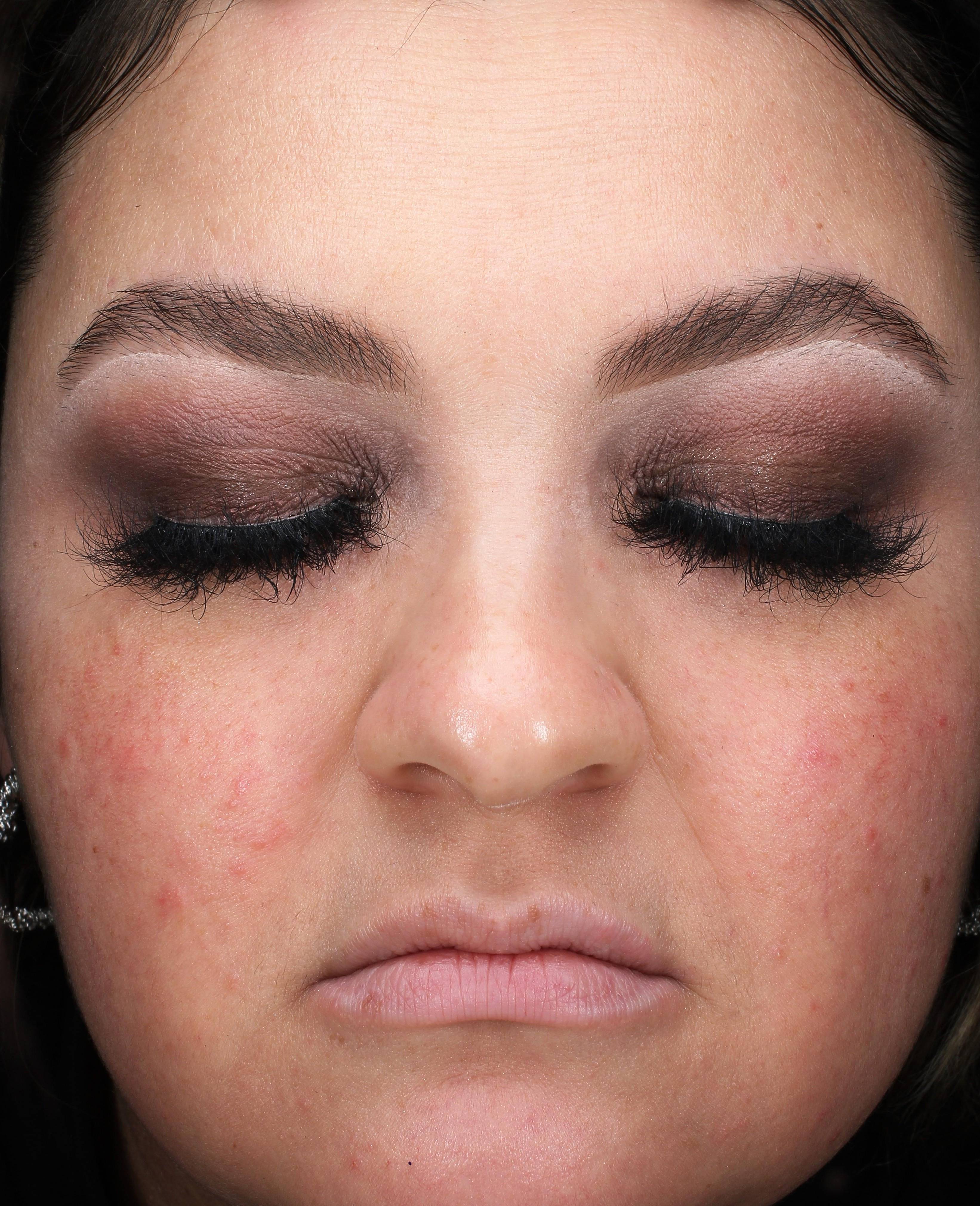 IPL-Photofacial/BBL Before and After Case 9 Before