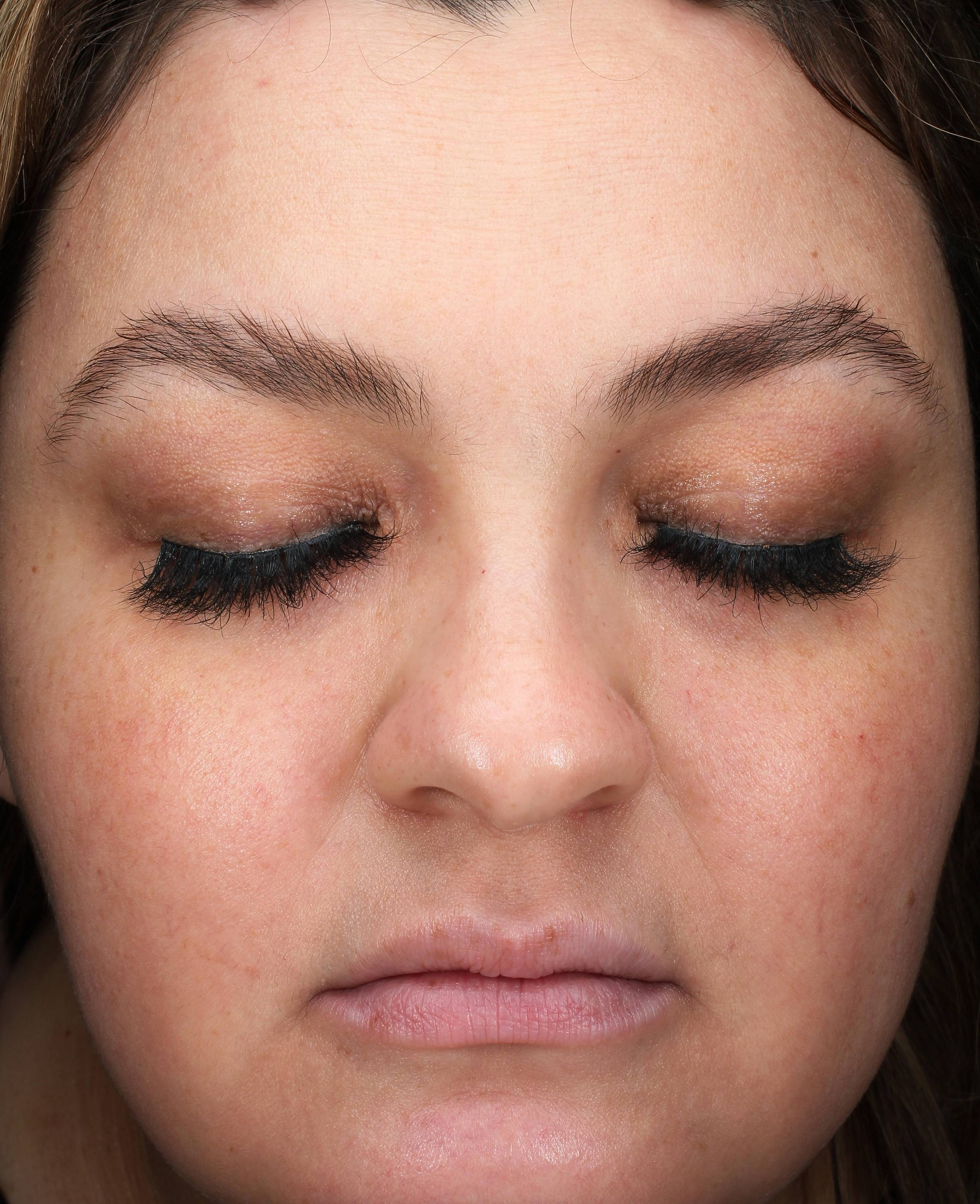 IPL-Photofacial/BBL Before and After Case 9 After