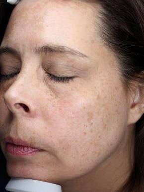 Picocare 450 Before and After Case 2 After