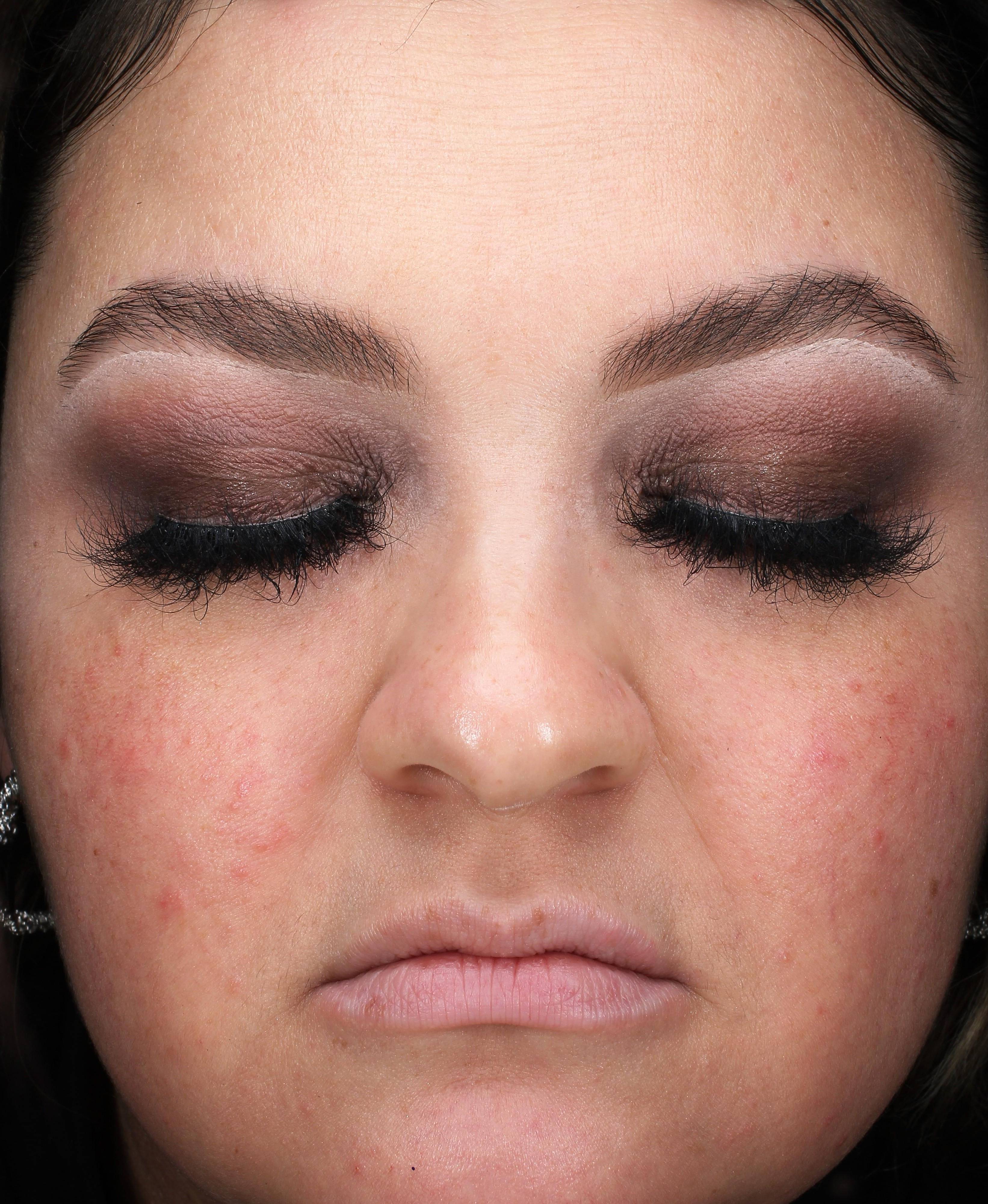 Rosacea Before and After Case 3 Before