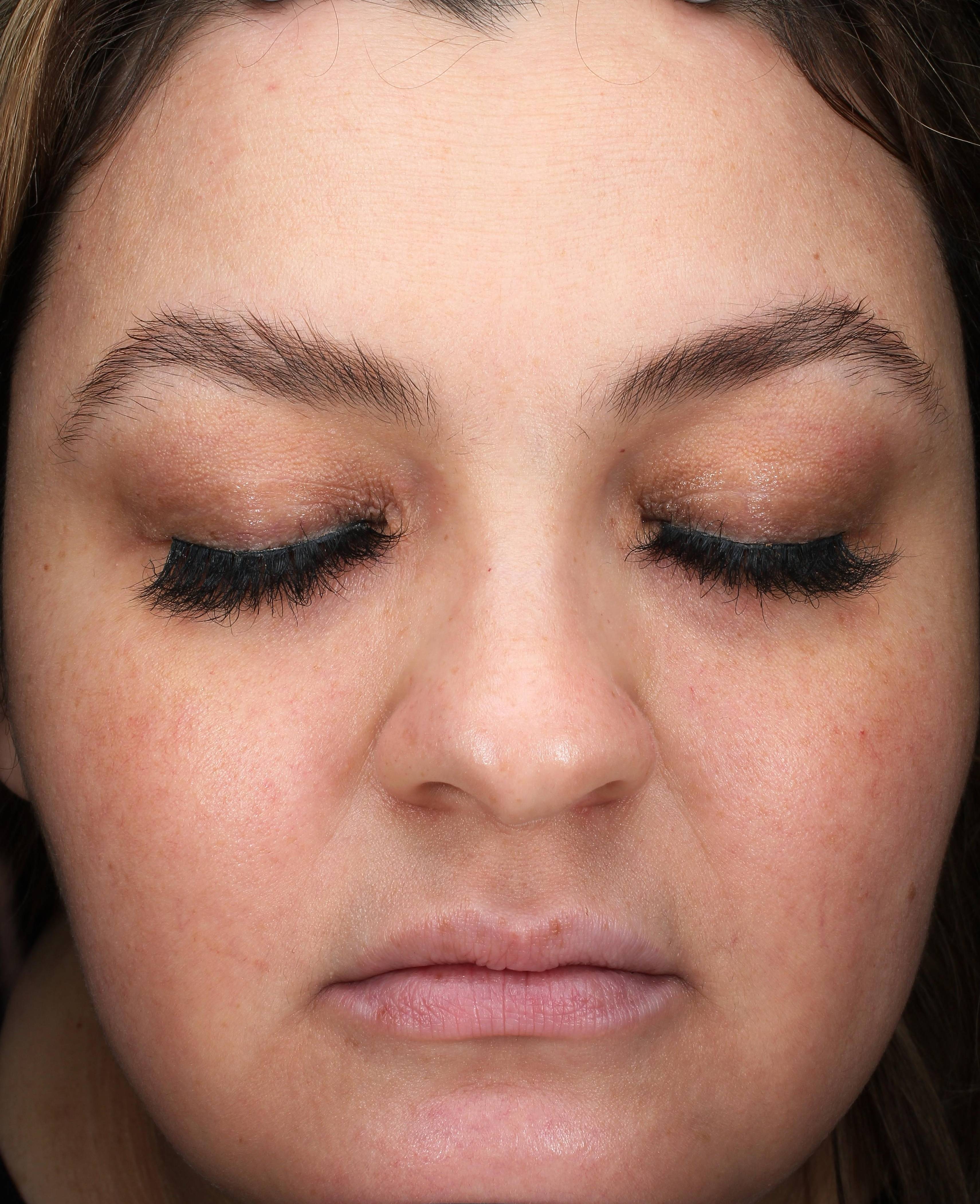 Rosacea Before and After Case 3 After
