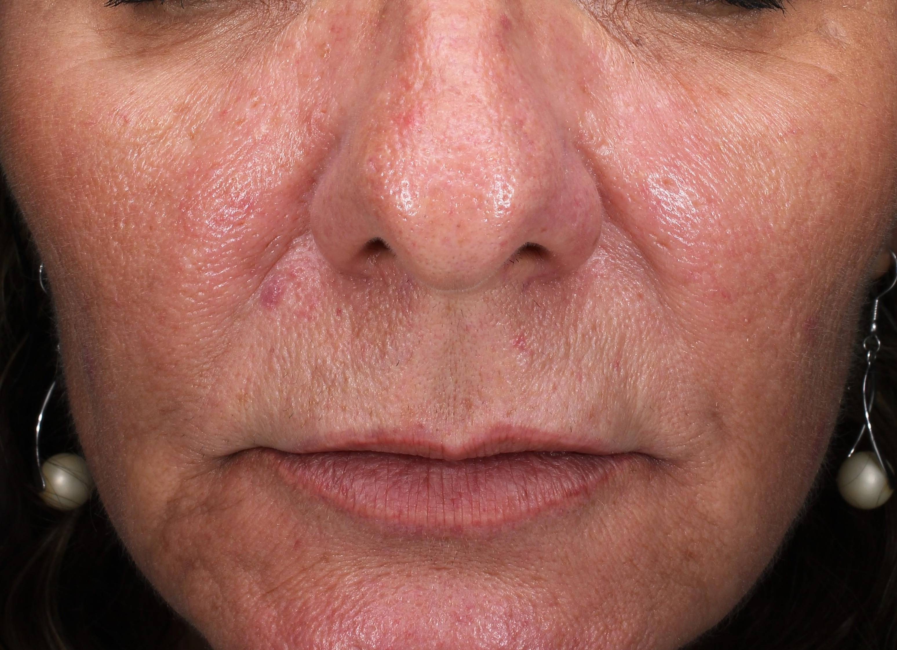 IPL-Photofacial/BBL Before and After Case 10 After
