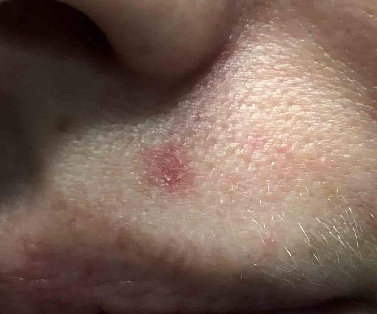 Skin Cancer (15 Treatments) Case 10 Before