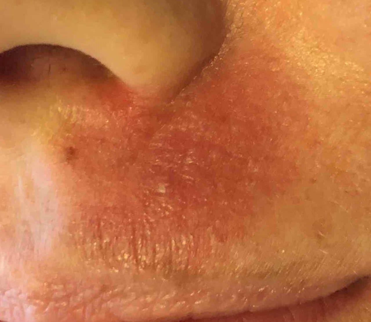 Skin Cancer (15 Treatments) Case 10 After