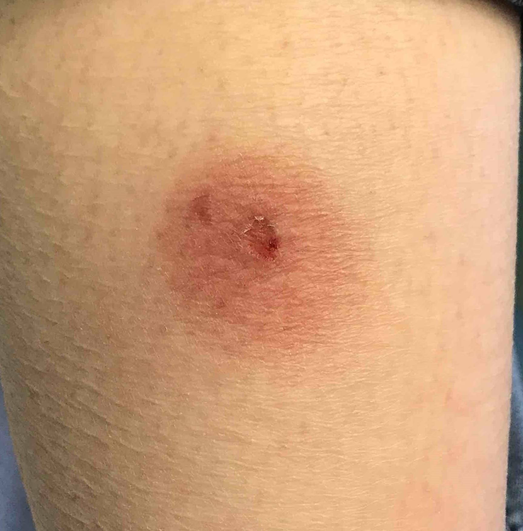 Skin Cancer Before and After Case 13 Before