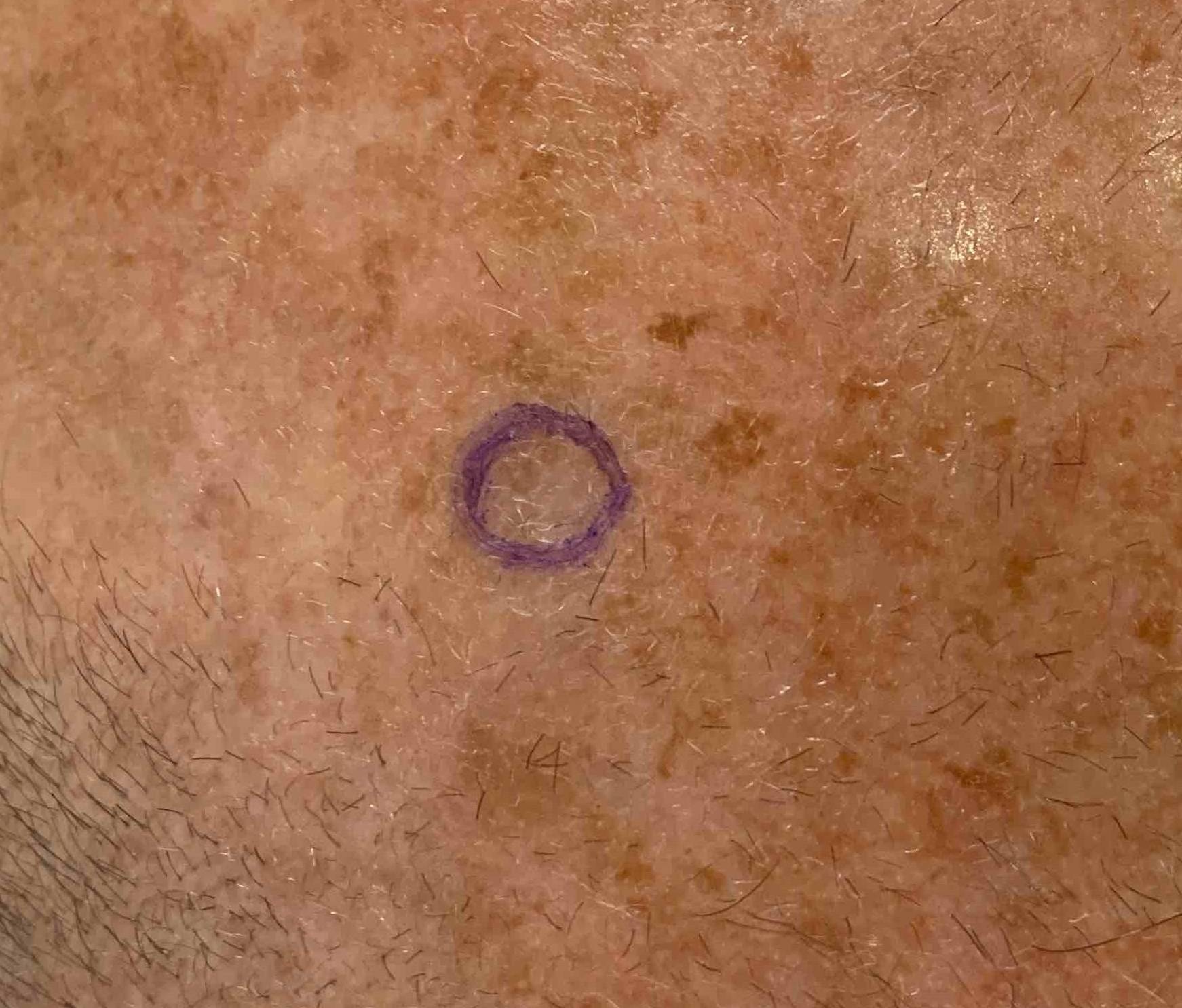 Skin Cancer Before and After Case 14 Before