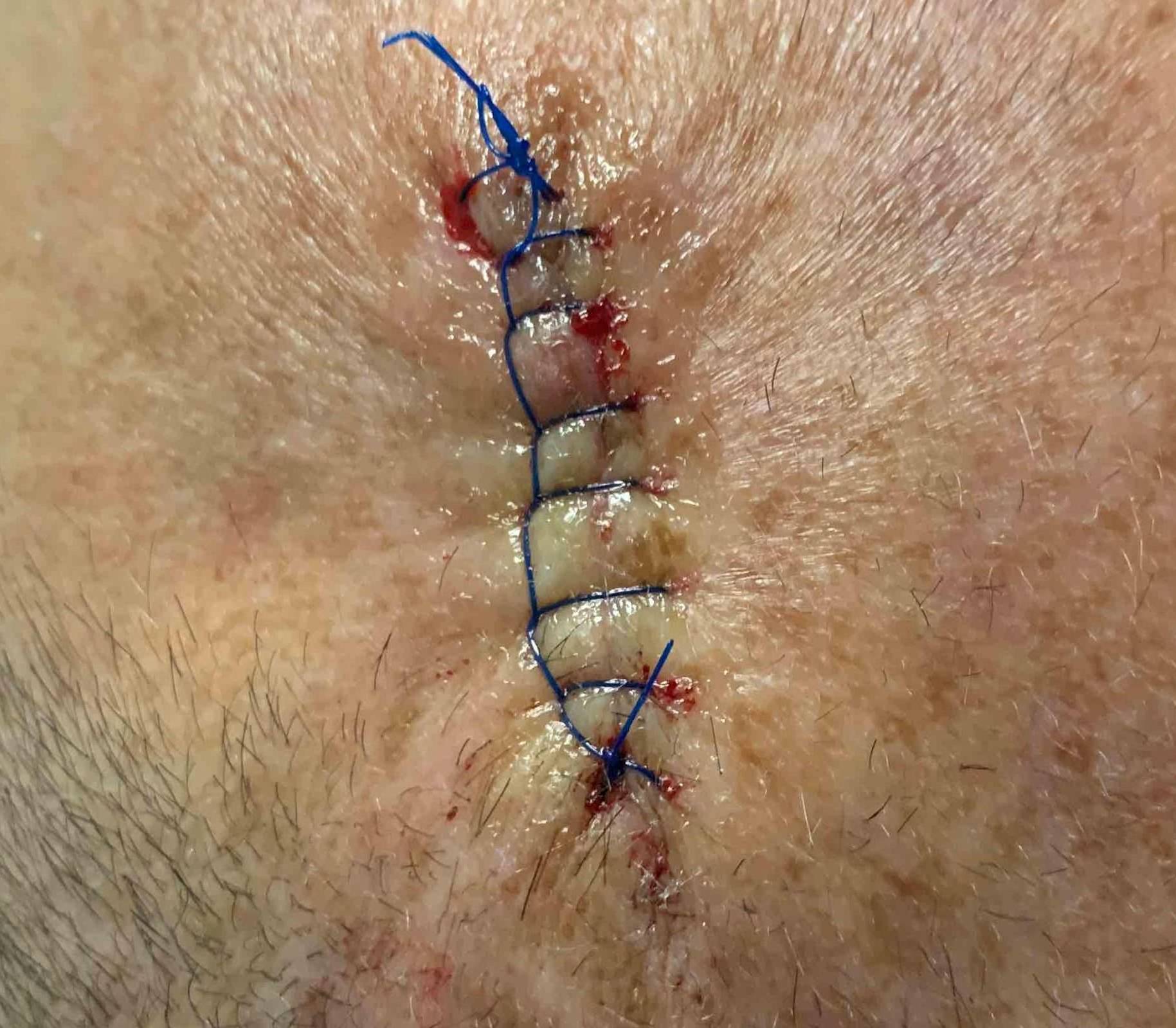 Skin Cancer Before and After Case 14 After