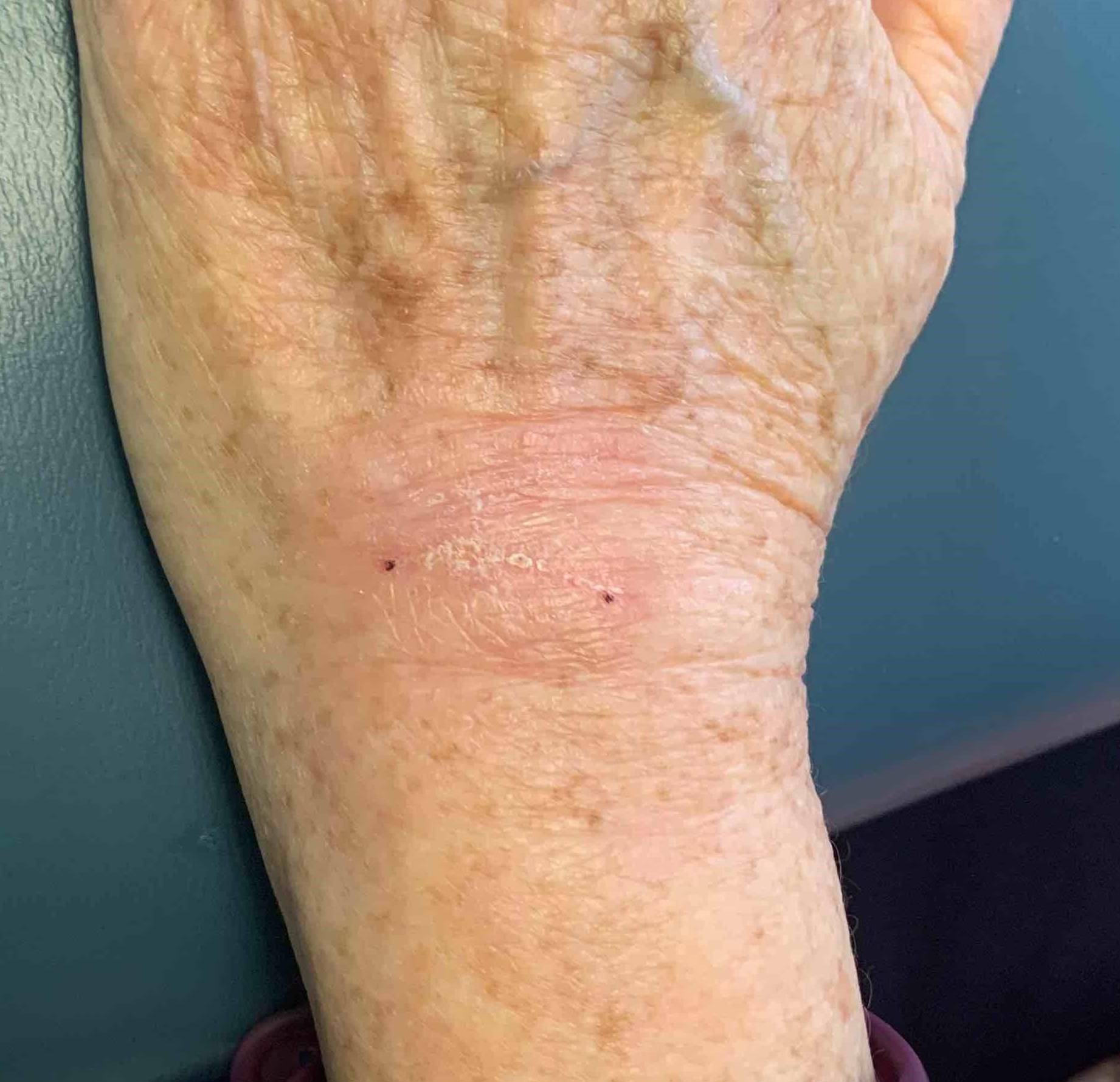 Skin Cancer Before and After Case 15 After