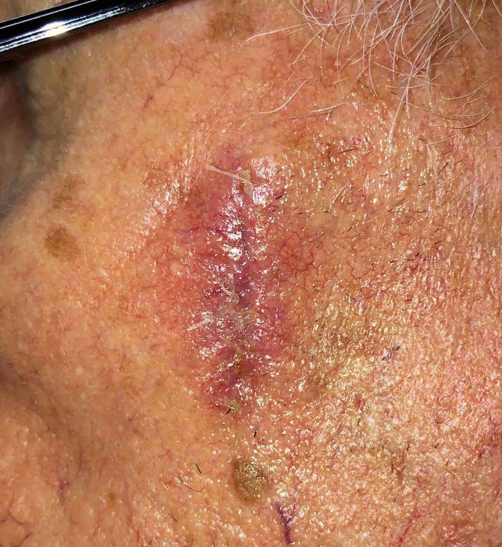 Skin Cancer Before and After Case 16 After