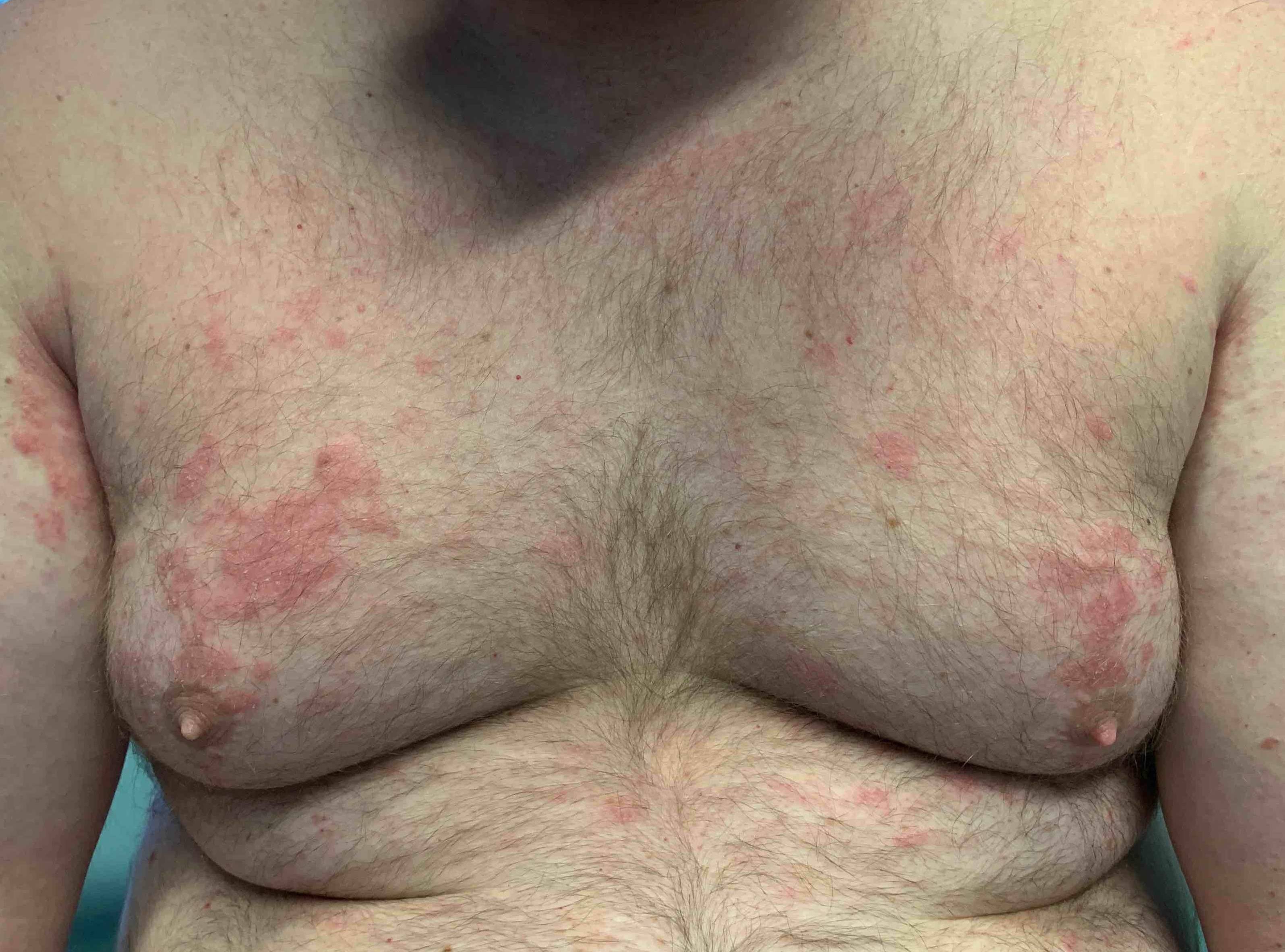 Eczema Case Before and After Case 10 Before