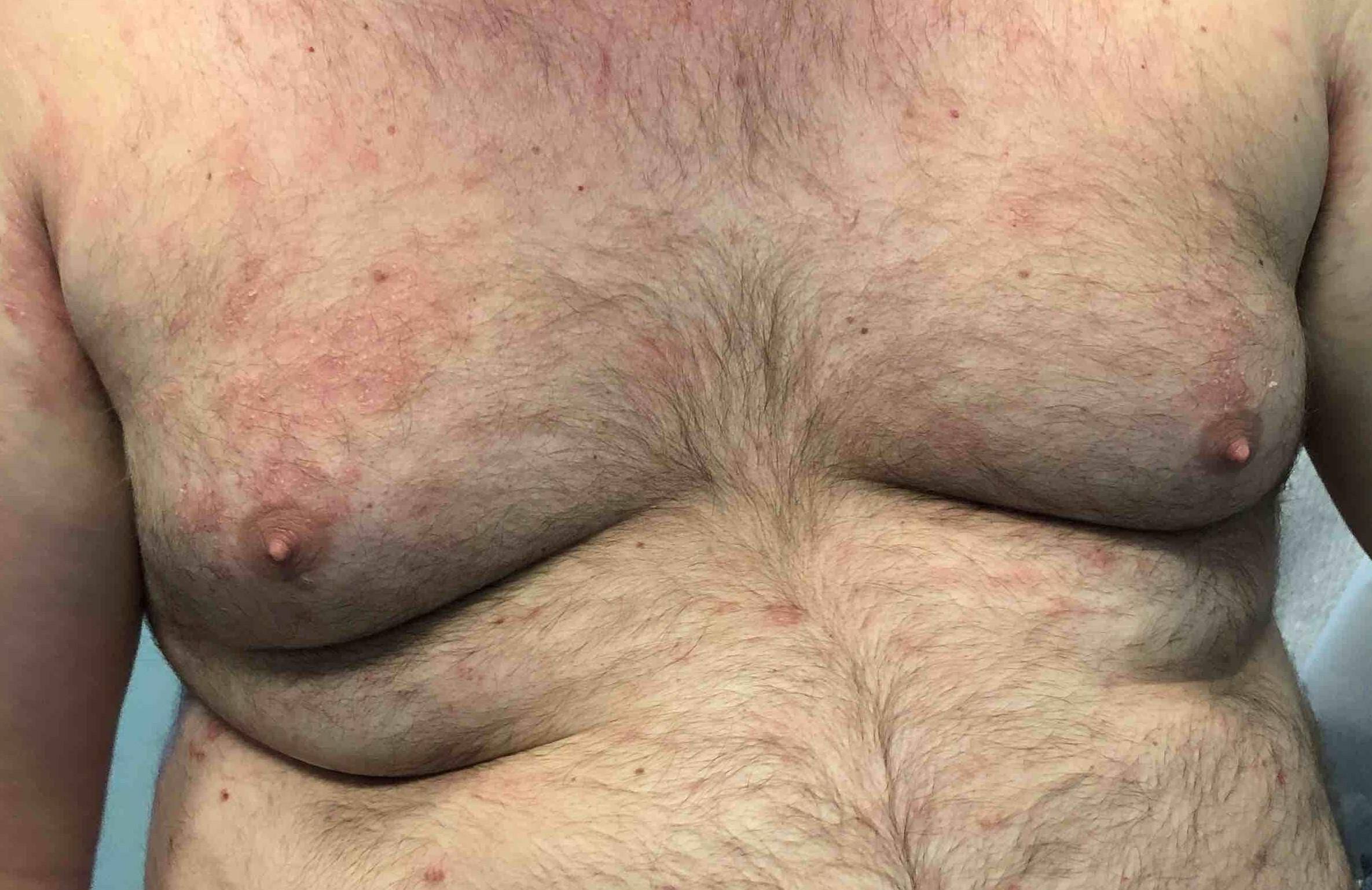 Eczema Case Before and After Case 10 After