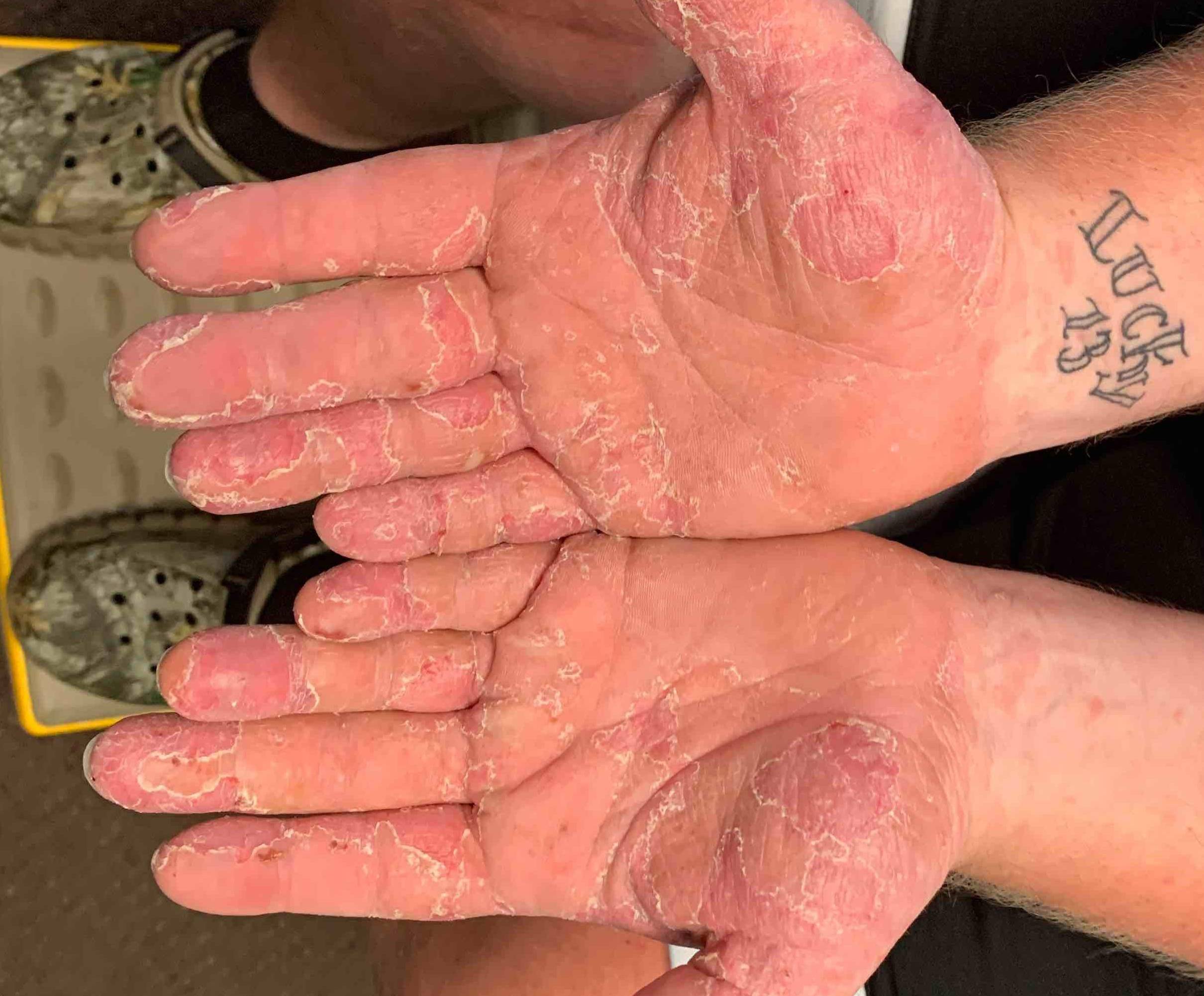Eczema/ Atopic Dermatitis Before and After Case 11 Before
